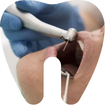 Mică chirurgie dentară: extracție molar de minte, rezecție apicală